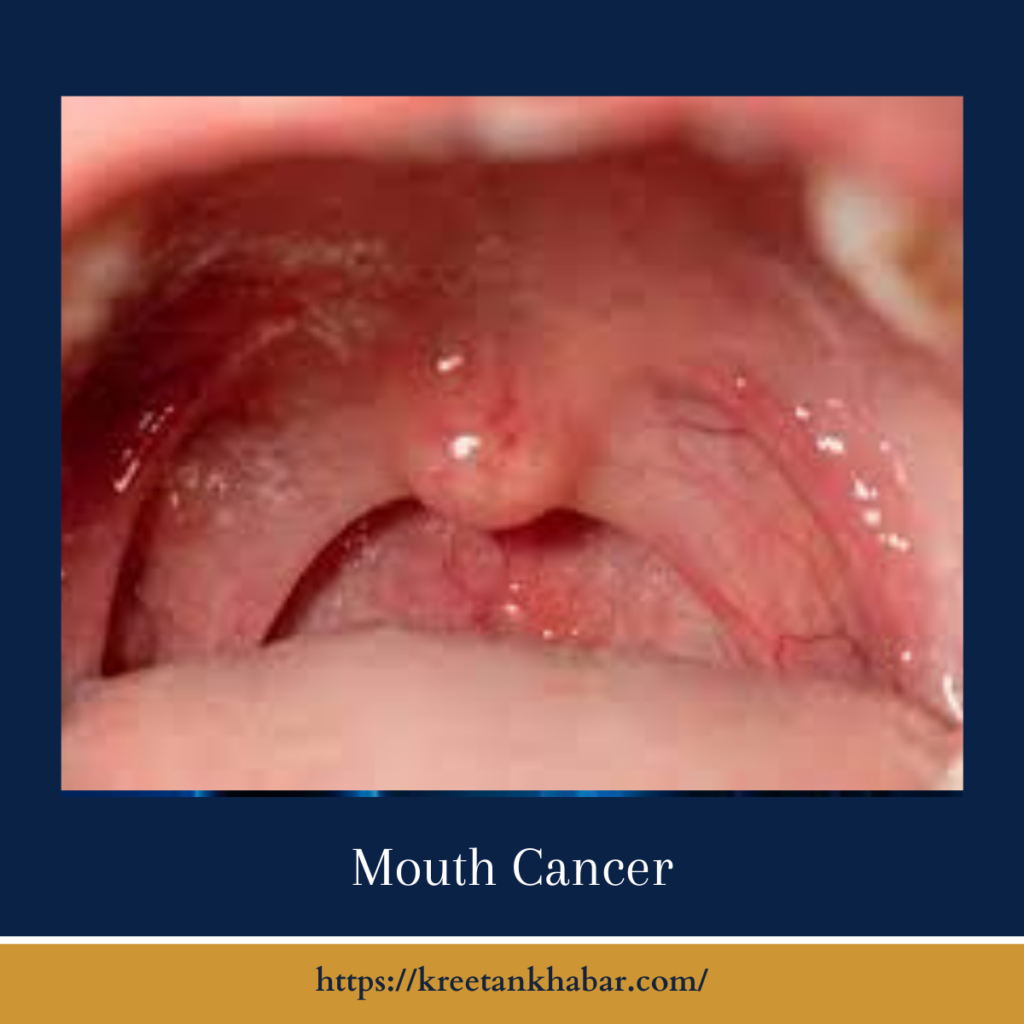 mouth cancer