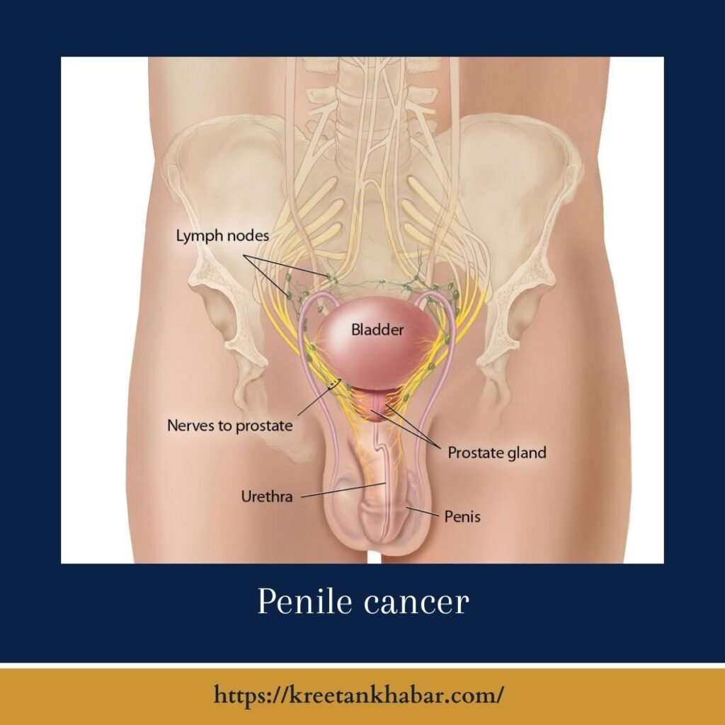 Penile cancer
