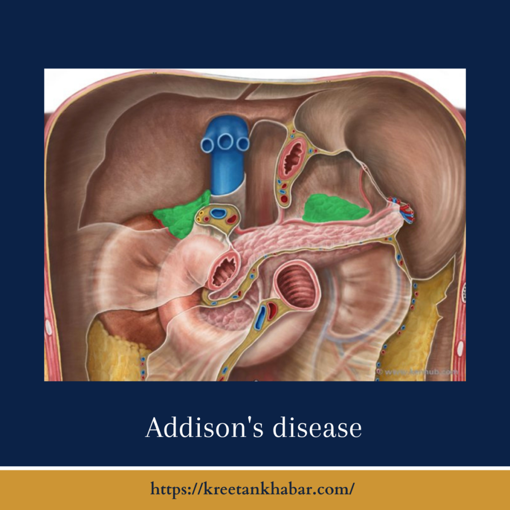 Addison's Disease
