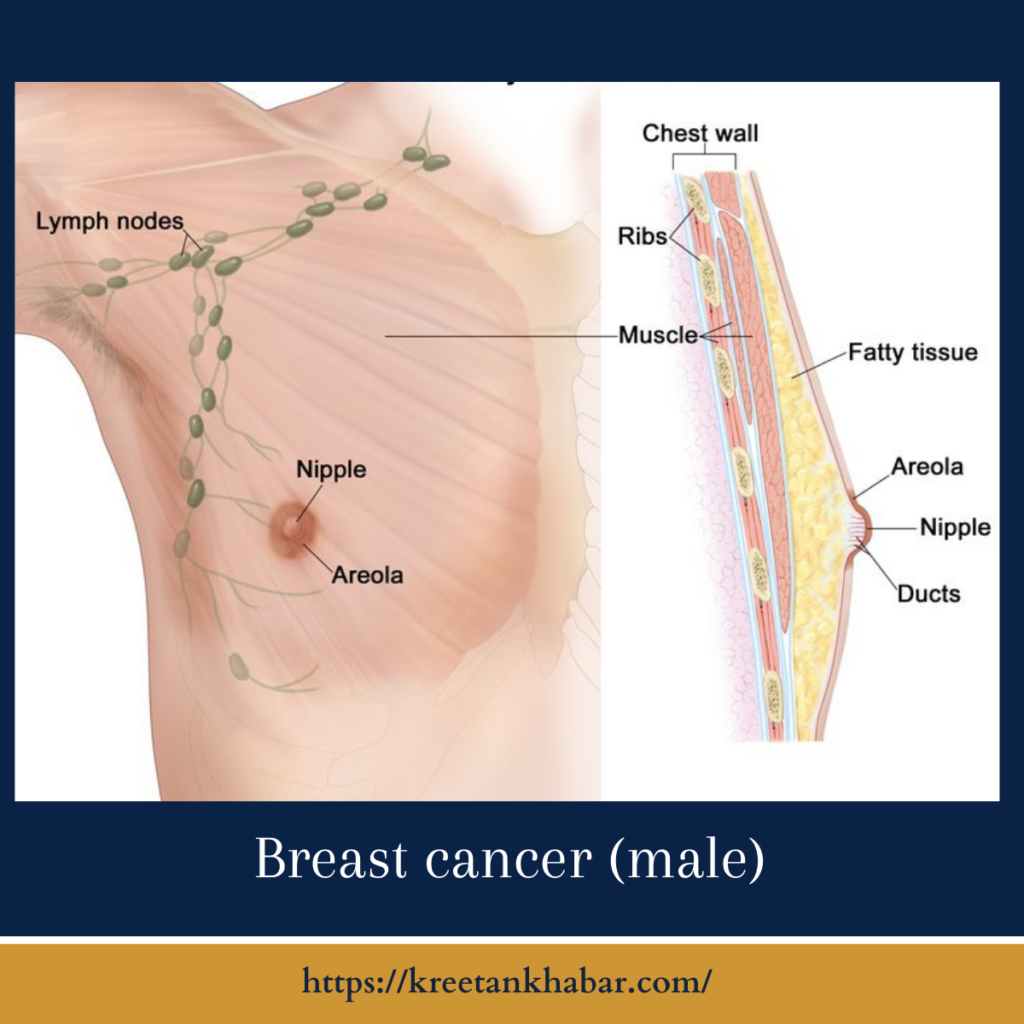 Breast cancer (male)