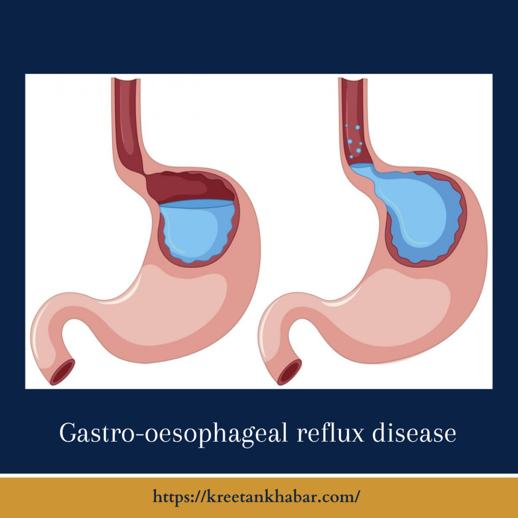 Gastro-oesophageal reflux disease