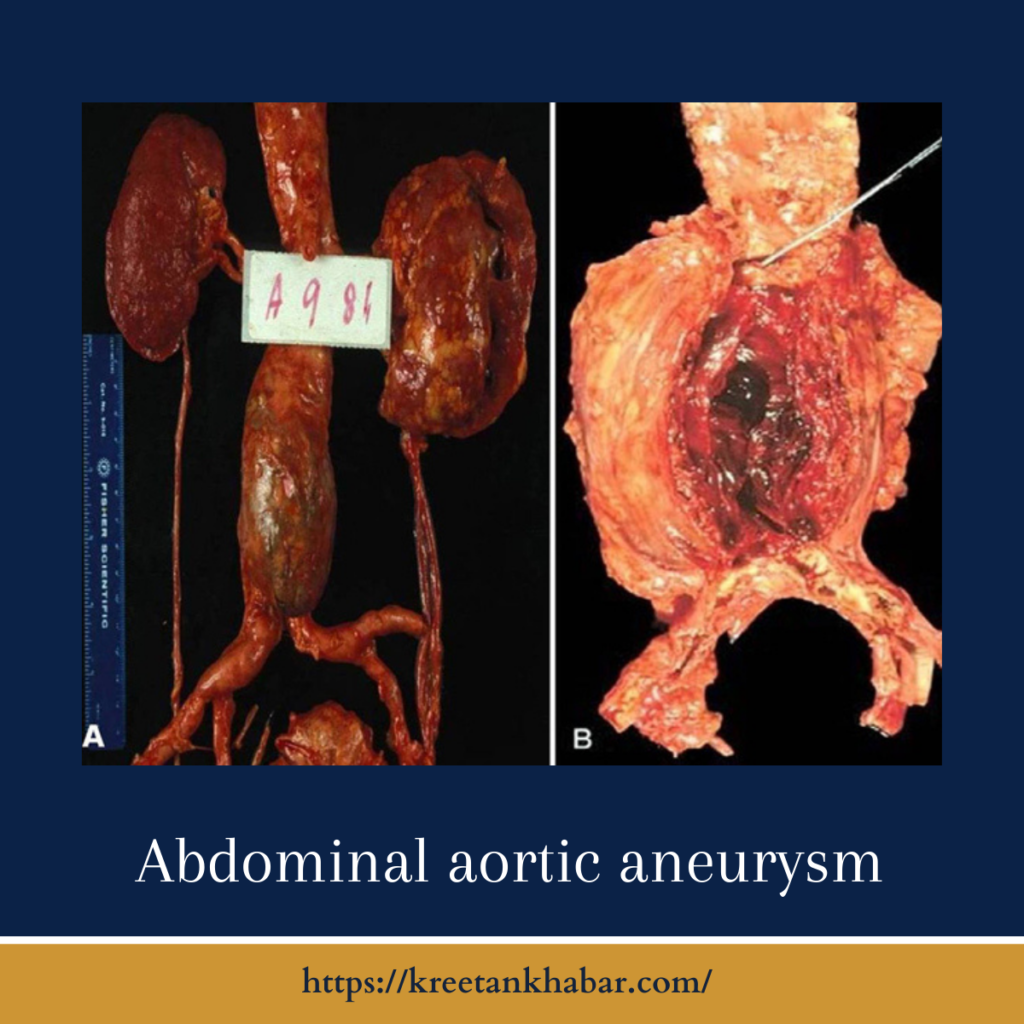 Abdominal aortic aneurysm
