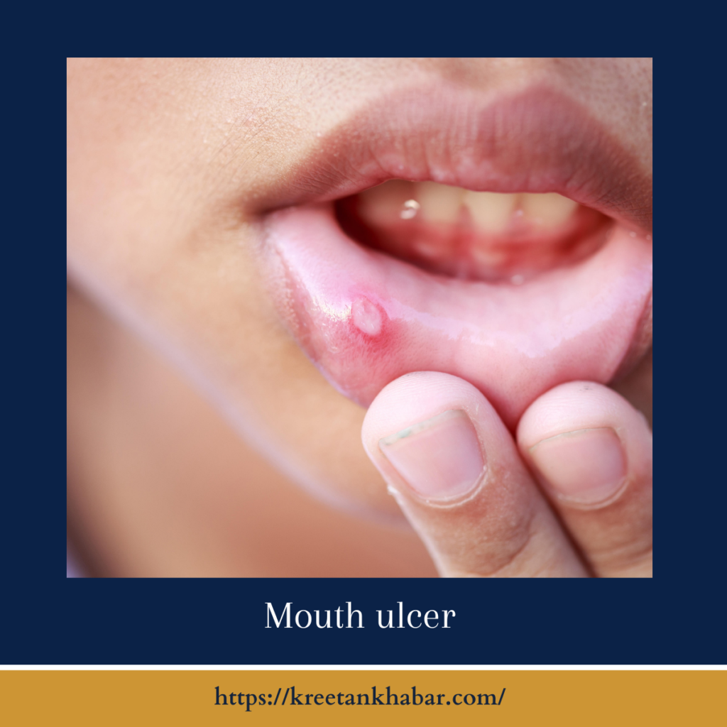 Mouth ulcer
