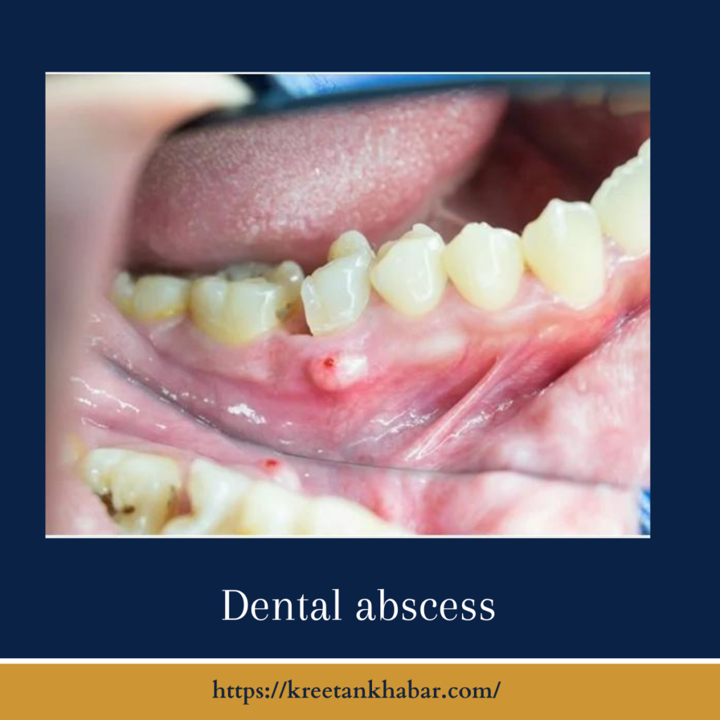 Dental abscess
