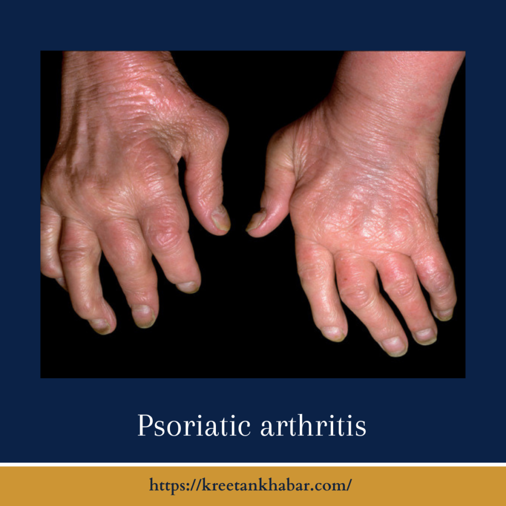 Psoriatic arthritis
