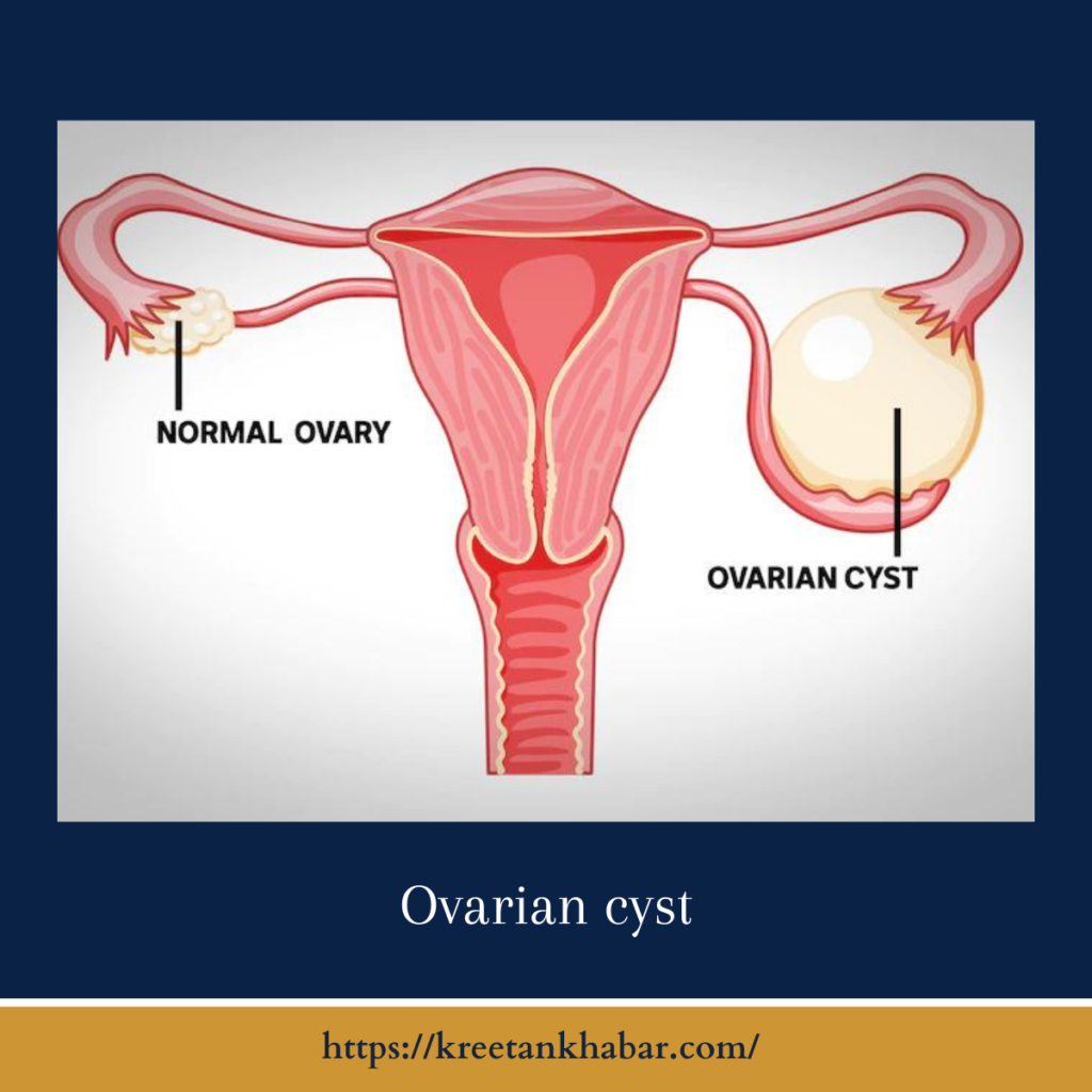 Ovarian cyst
