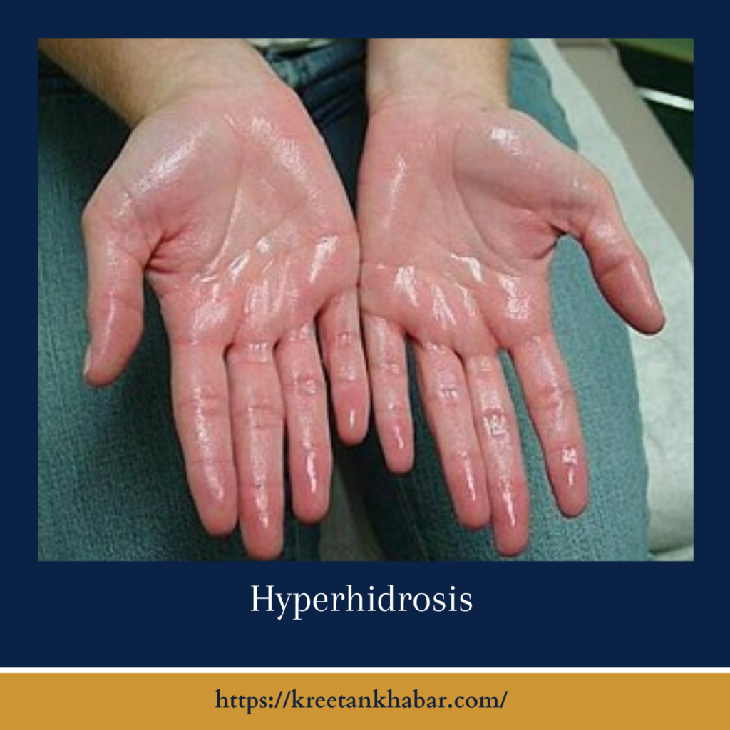 Hyperhidrosis
