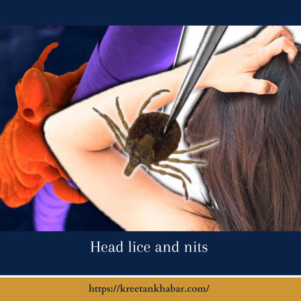 Head lice and nits
