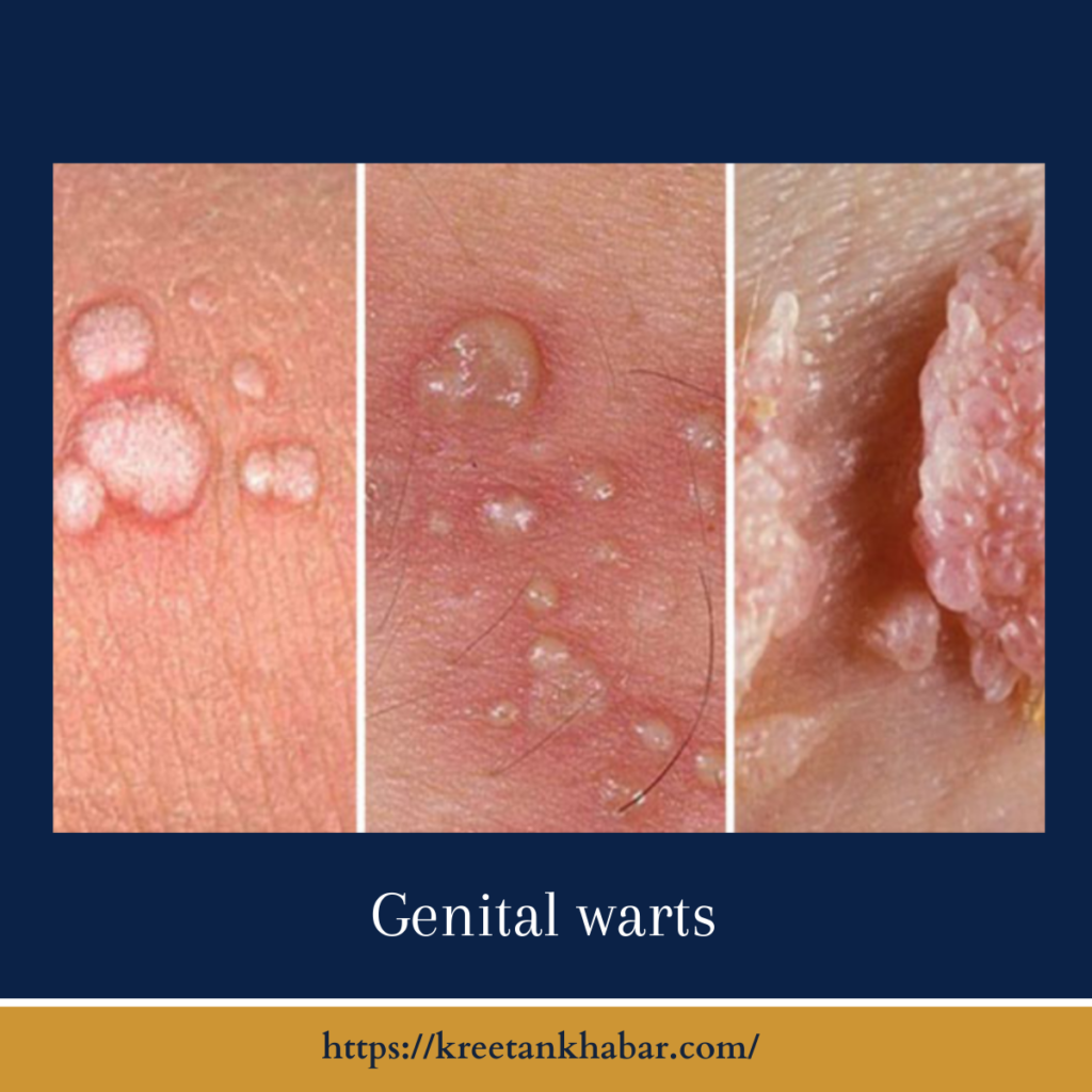Genital warts
