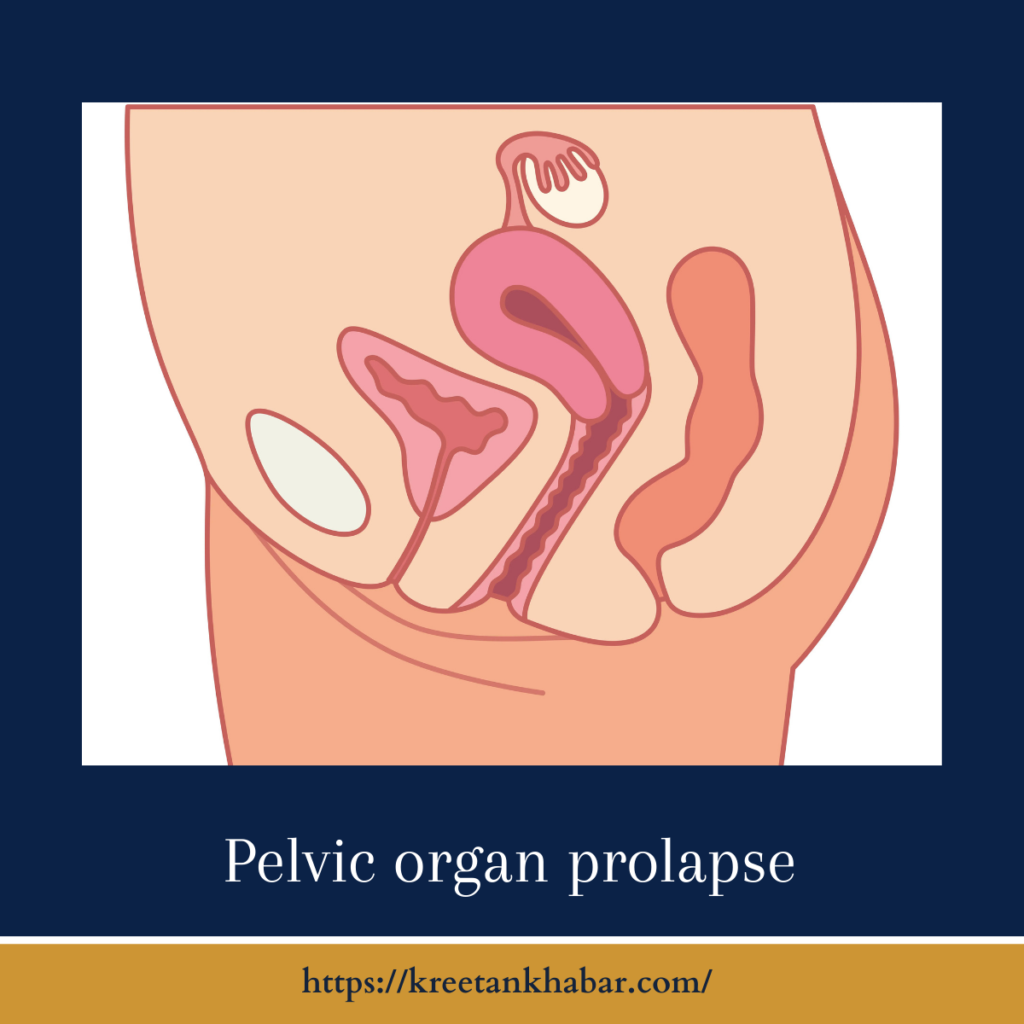 Pelvic organ prolapse
