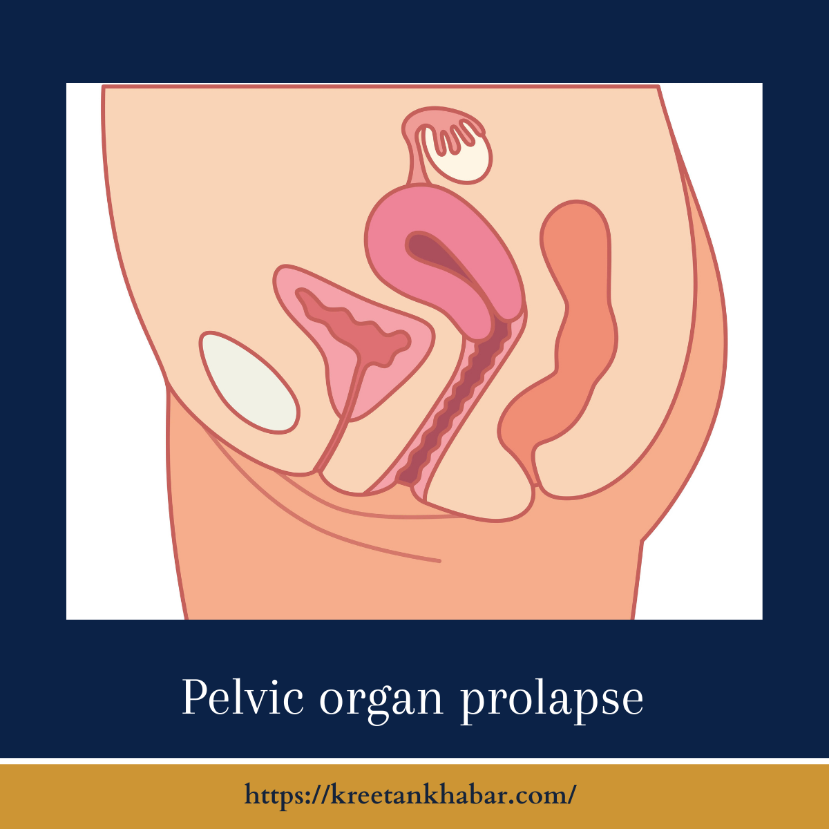 Understanding Pelvic Organ Prolapse Causes Symptoms And Treatment