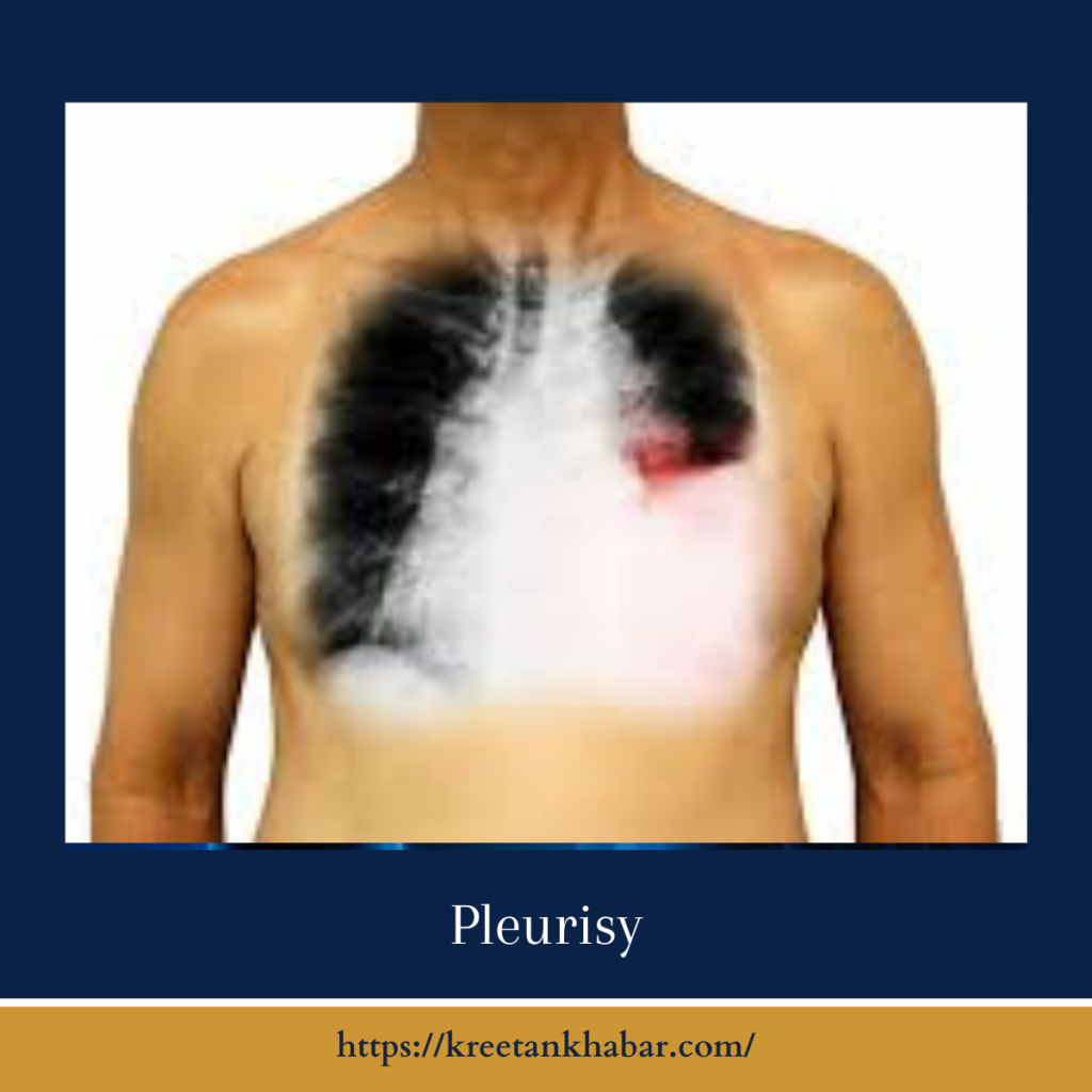 Pleurisy