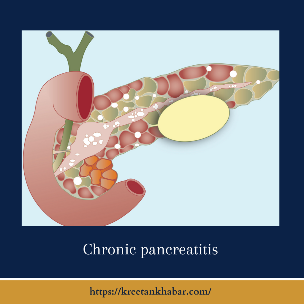 Chronic pancreatitis
