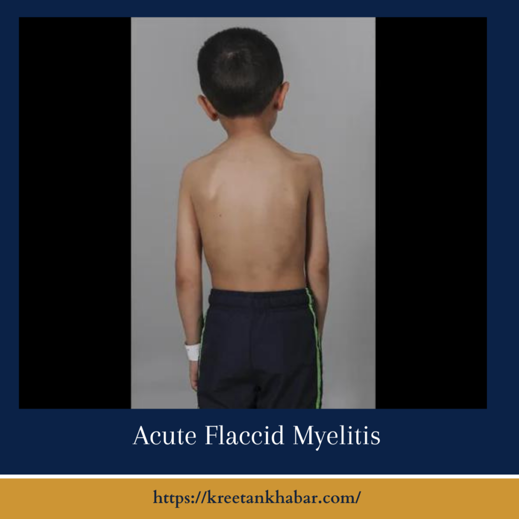 Acute Flaccid Myelitis