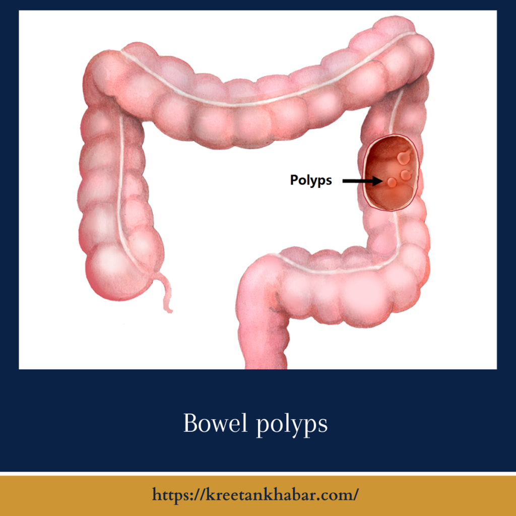 Bowel polyps
