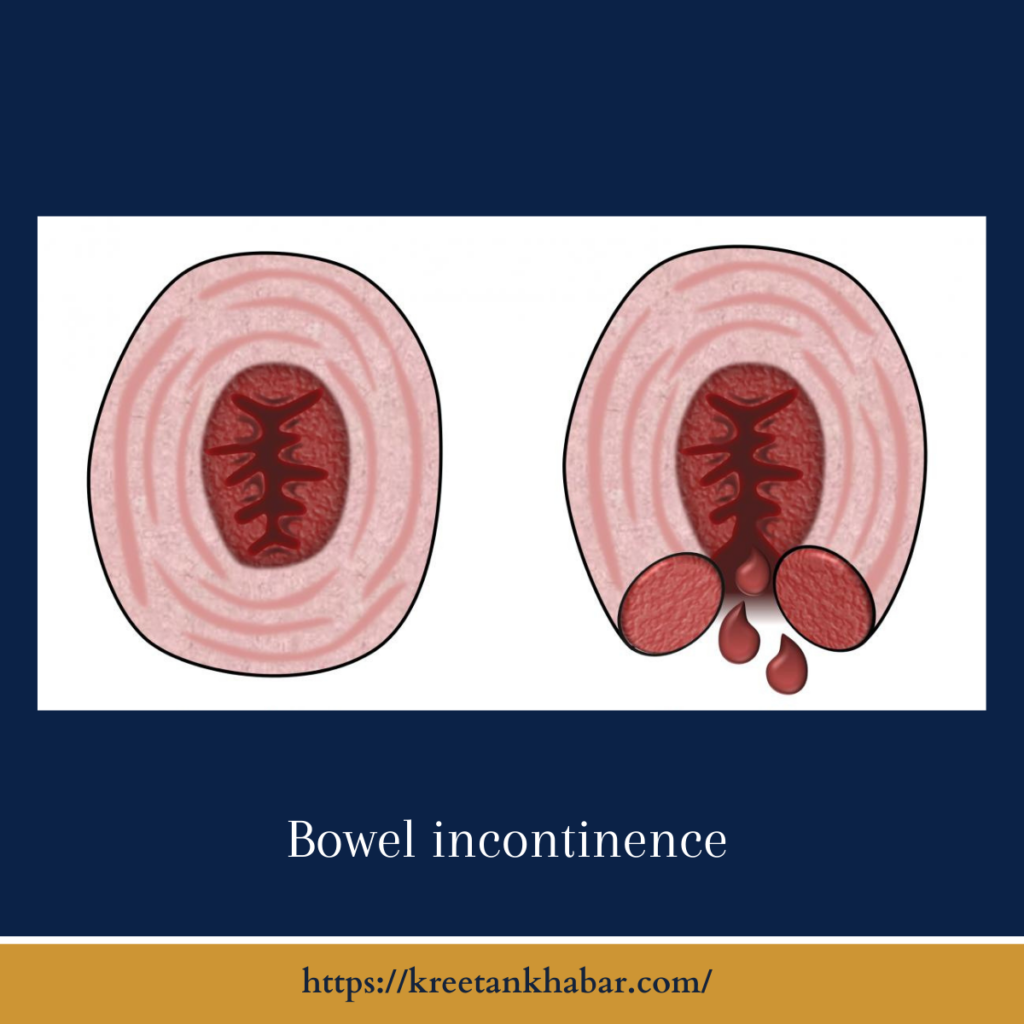 Bowel incontinence

