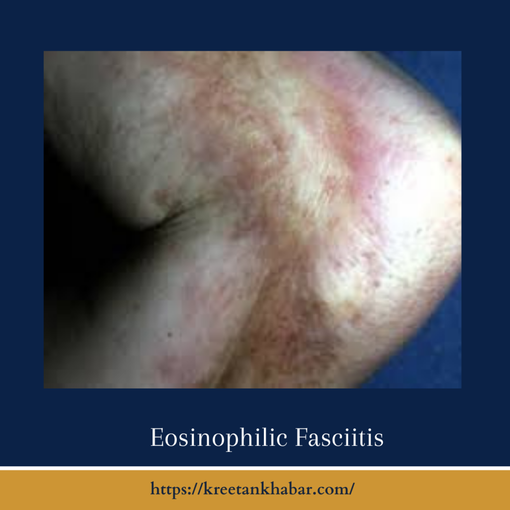 Eosinophilic Fasciitis
