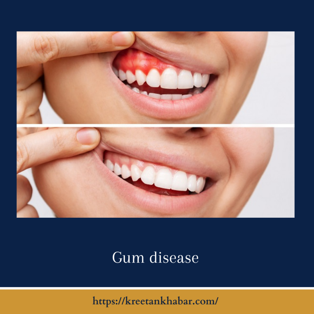 Gum disease
