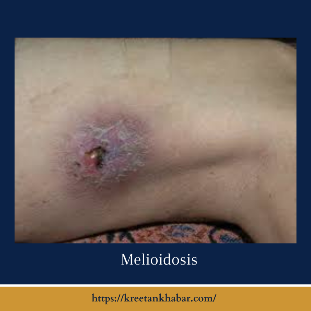 Melioidosis