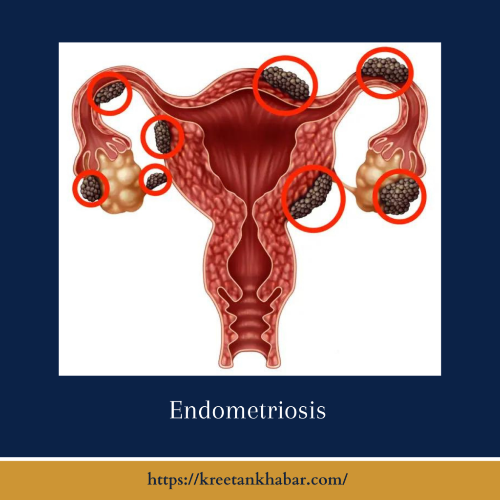 Endometriosis