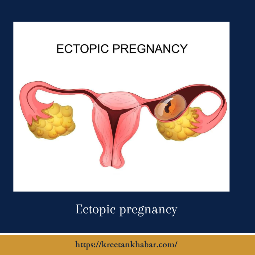 Ectopic pregnancy
