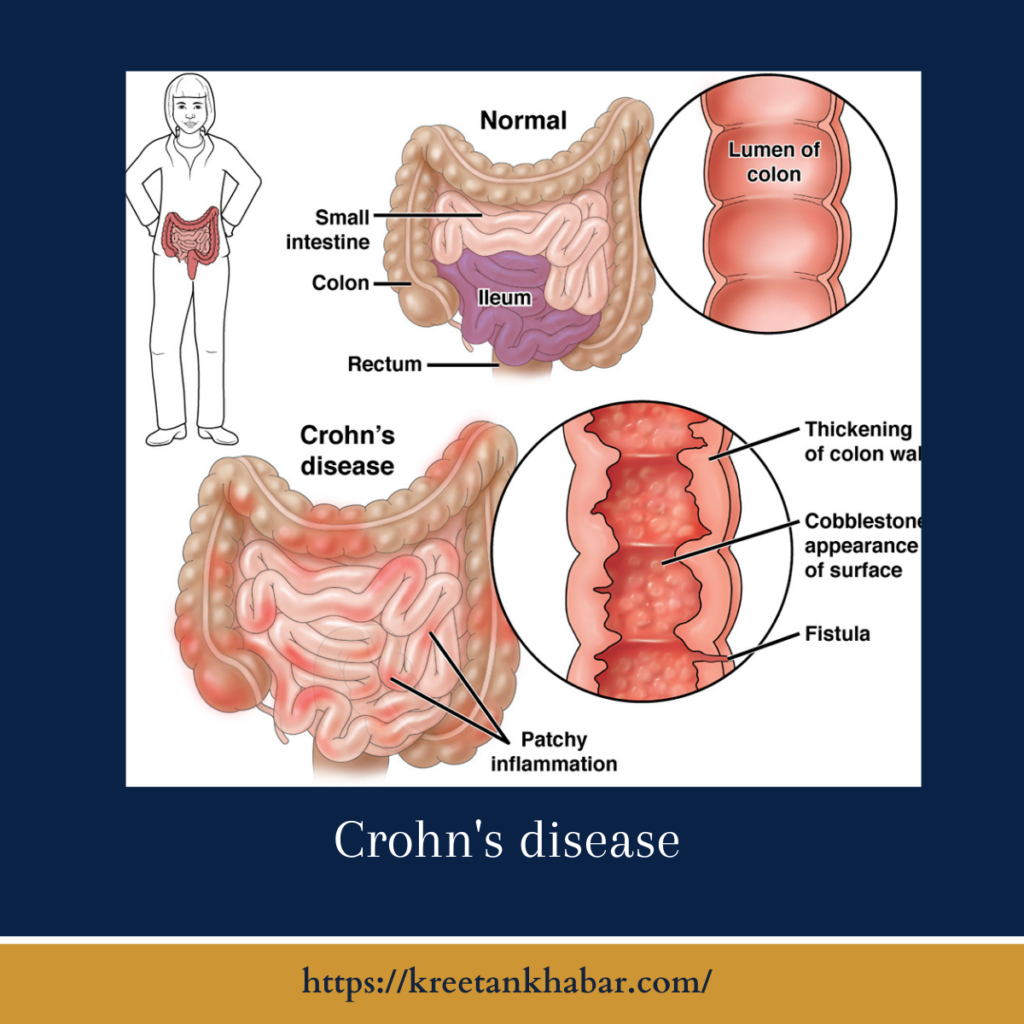 Crohn's disease
