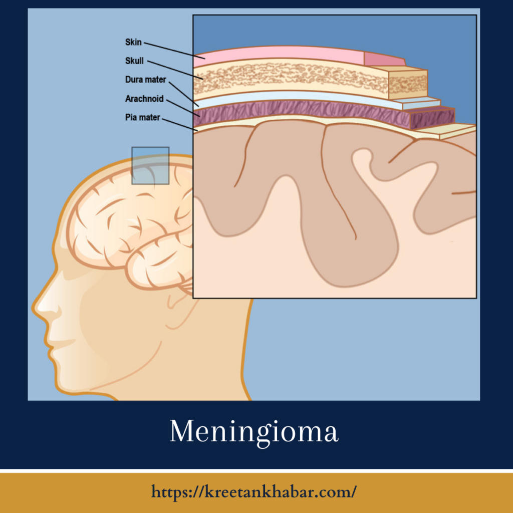 Meningioma