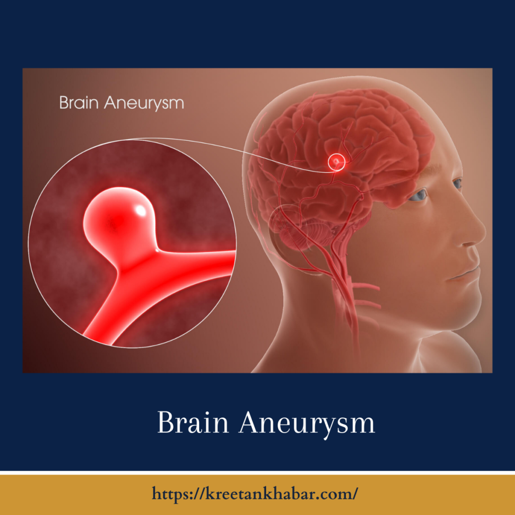 Brain Aneurysm