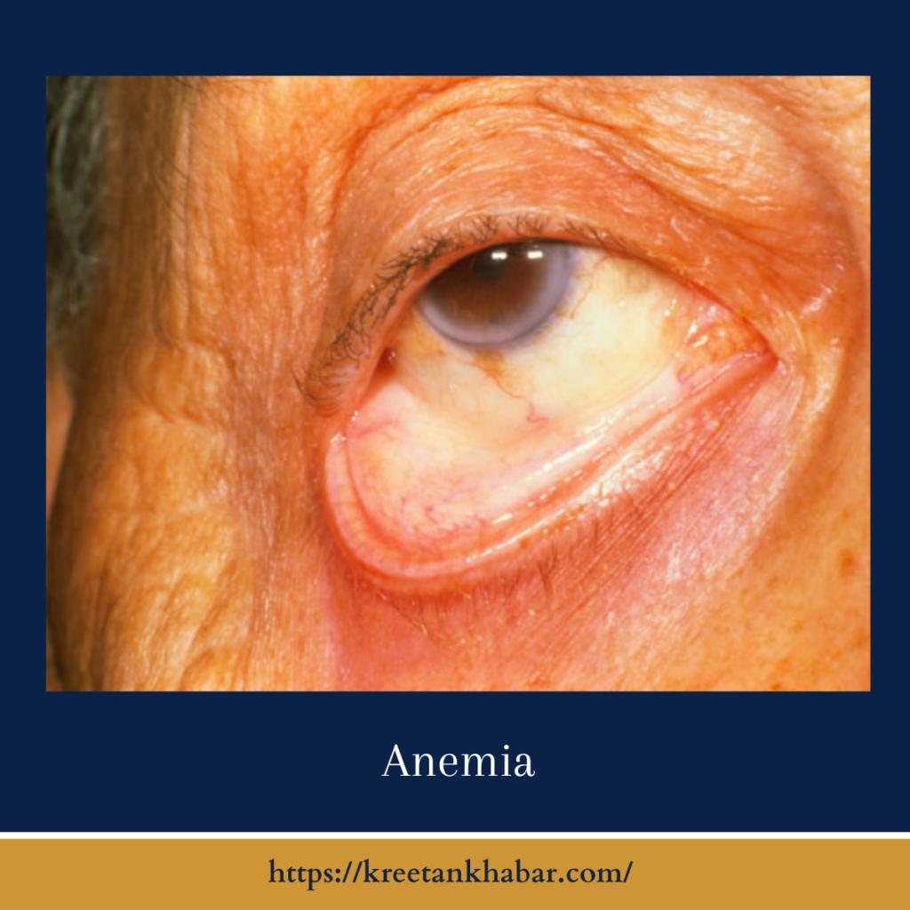 Anemia