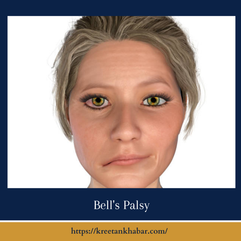 Bell's Palsy
