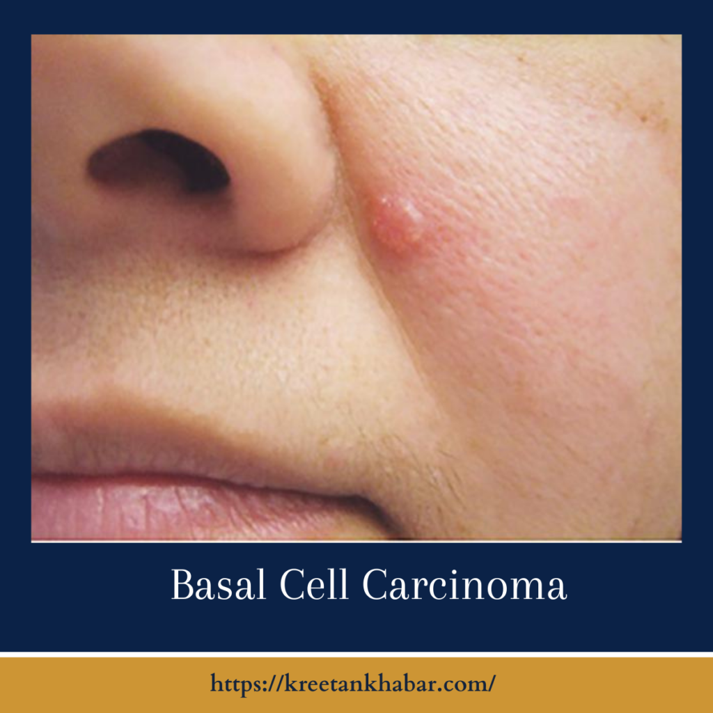 Basal Cell Carcinoma
