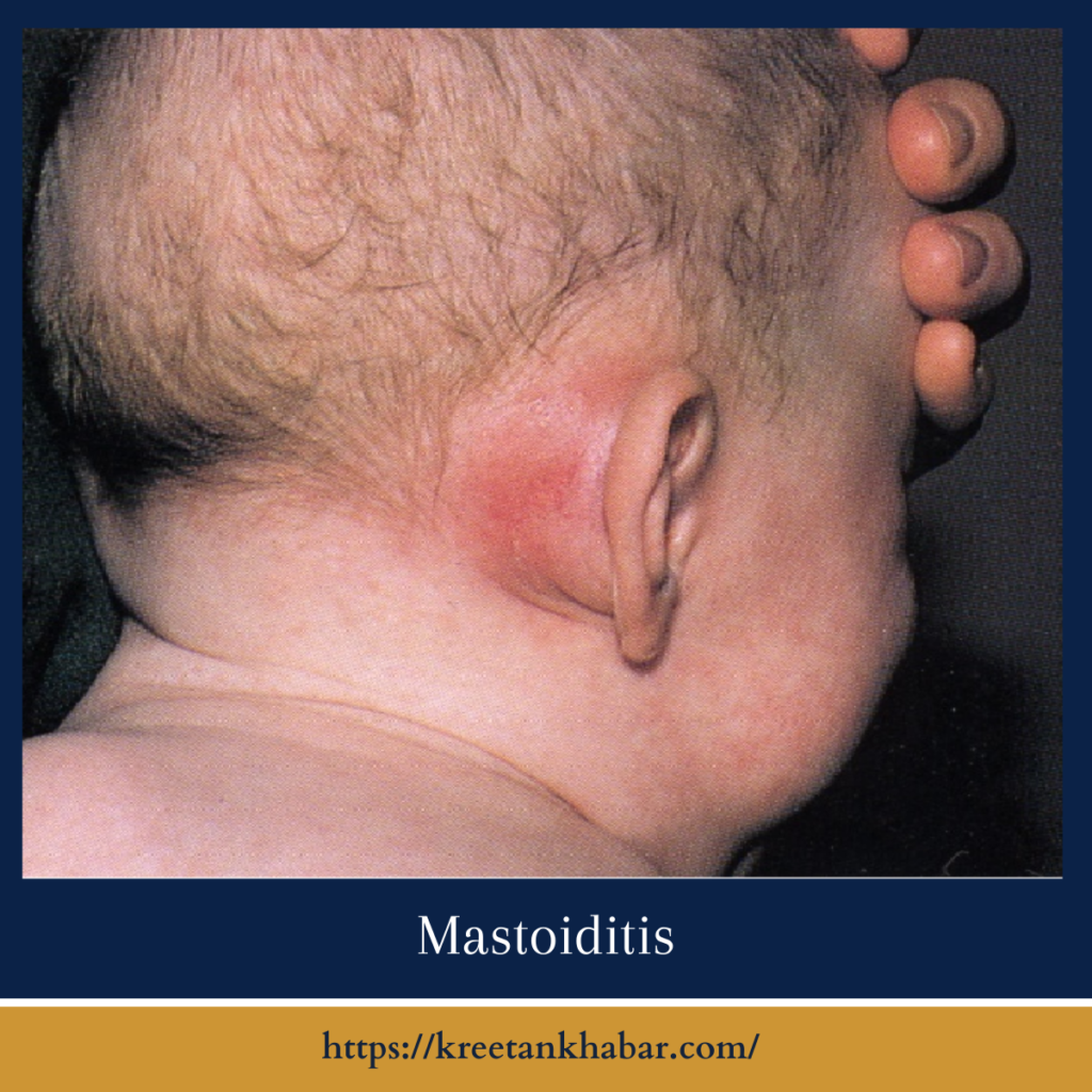 Mastoiditis
