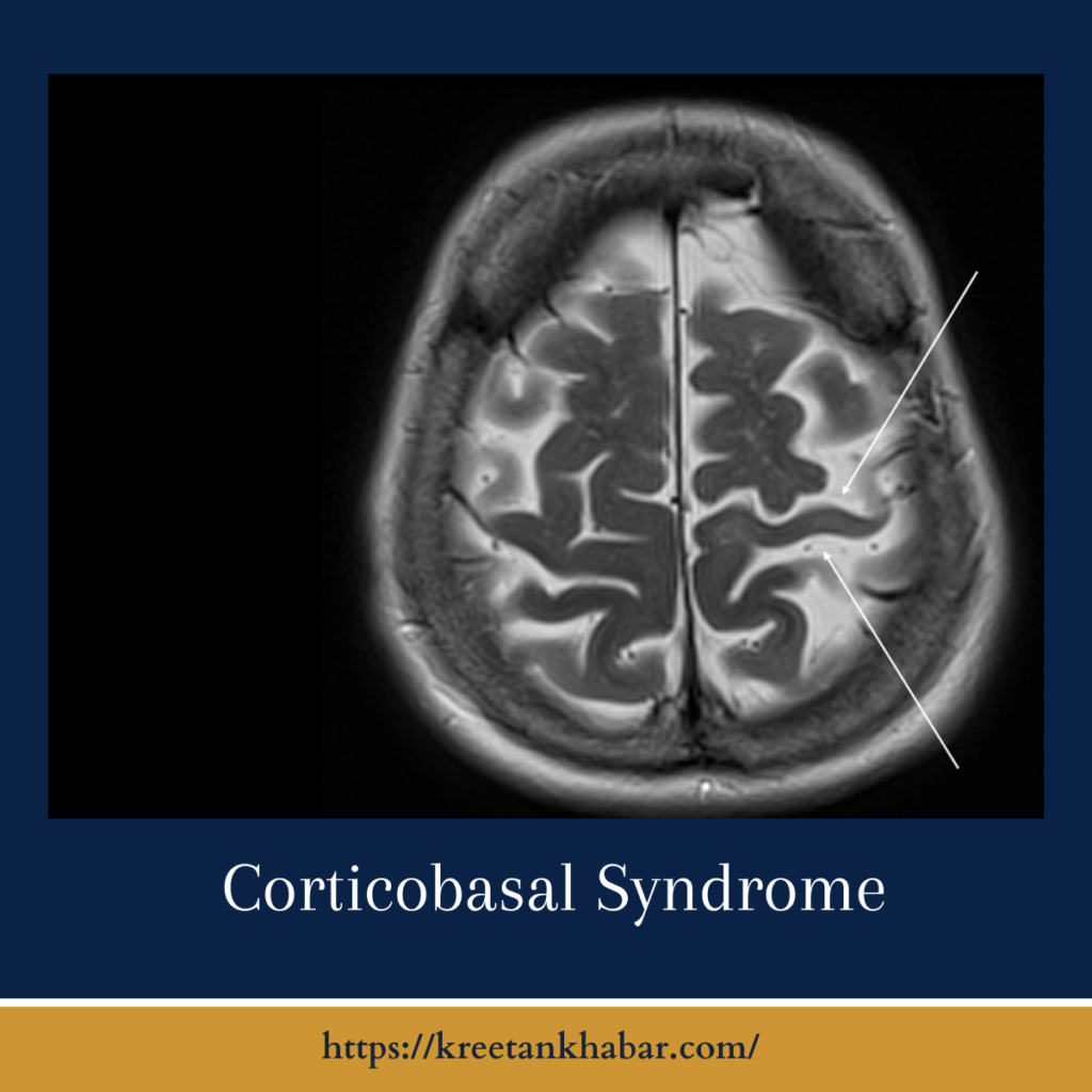 Corticobasal Syndrome