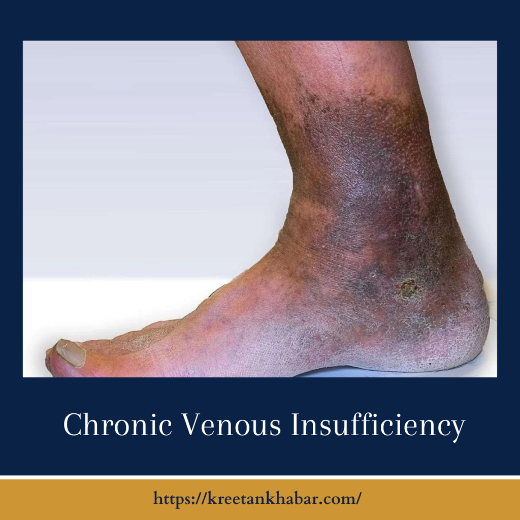 Chronic Venous Insufficiency