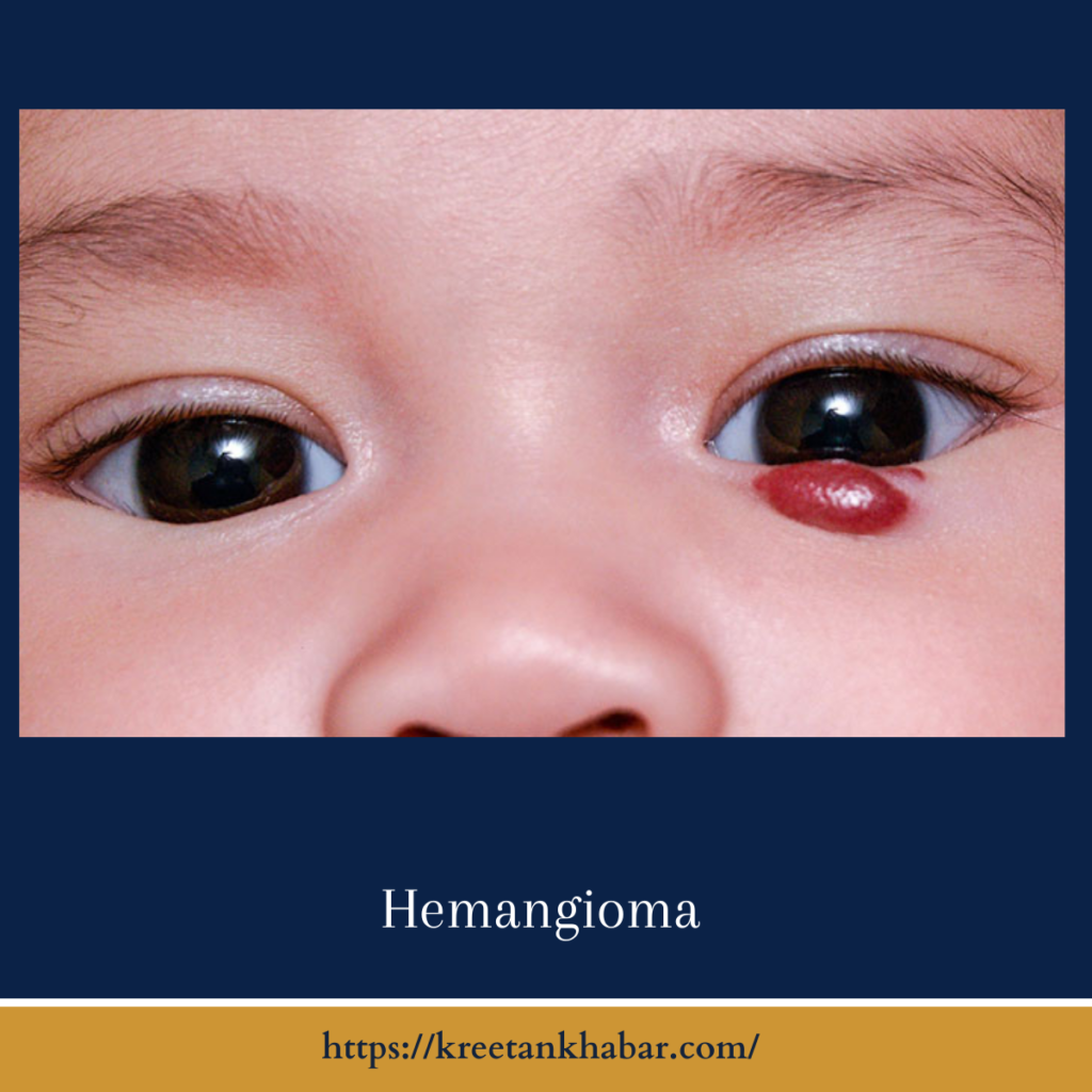 Hemangioma