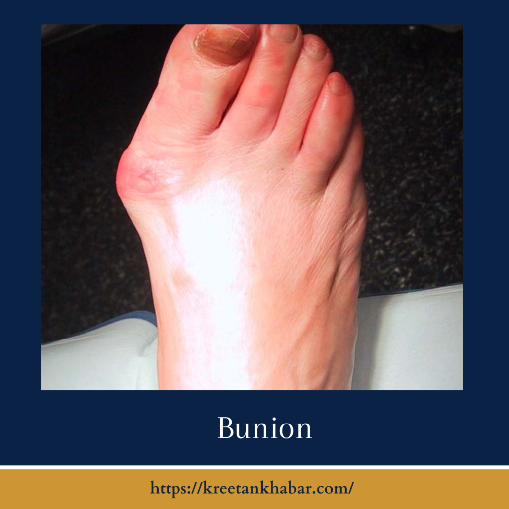 Bunion