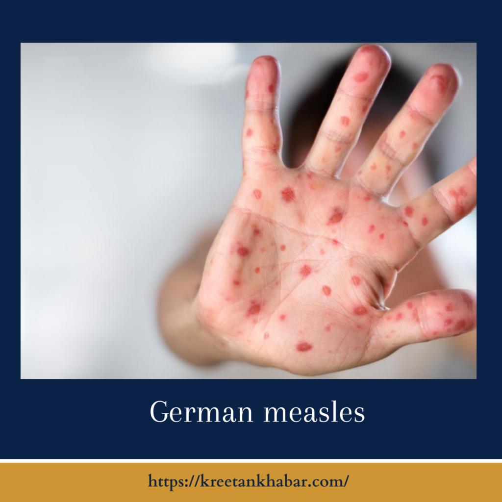 german measles