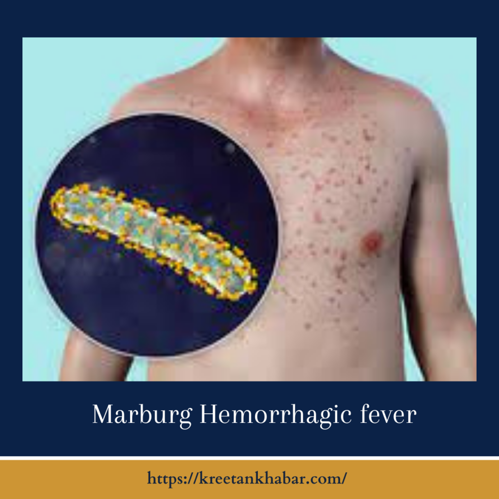 Marburg Hemorrhagic fever