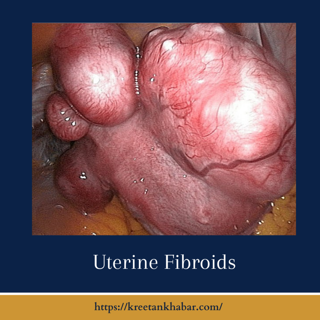 Uterine Fibroids