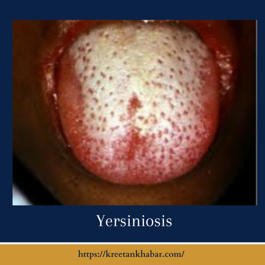 Yersiniosis