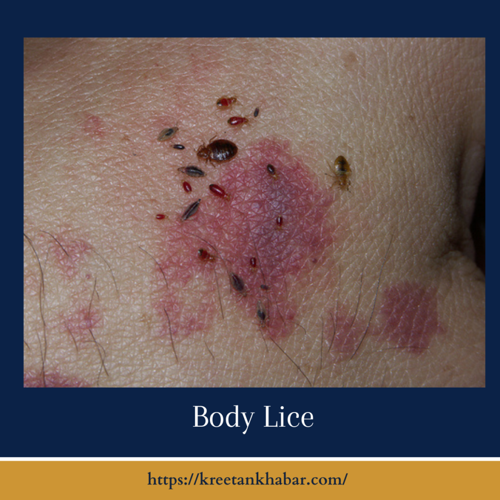 Body Lice