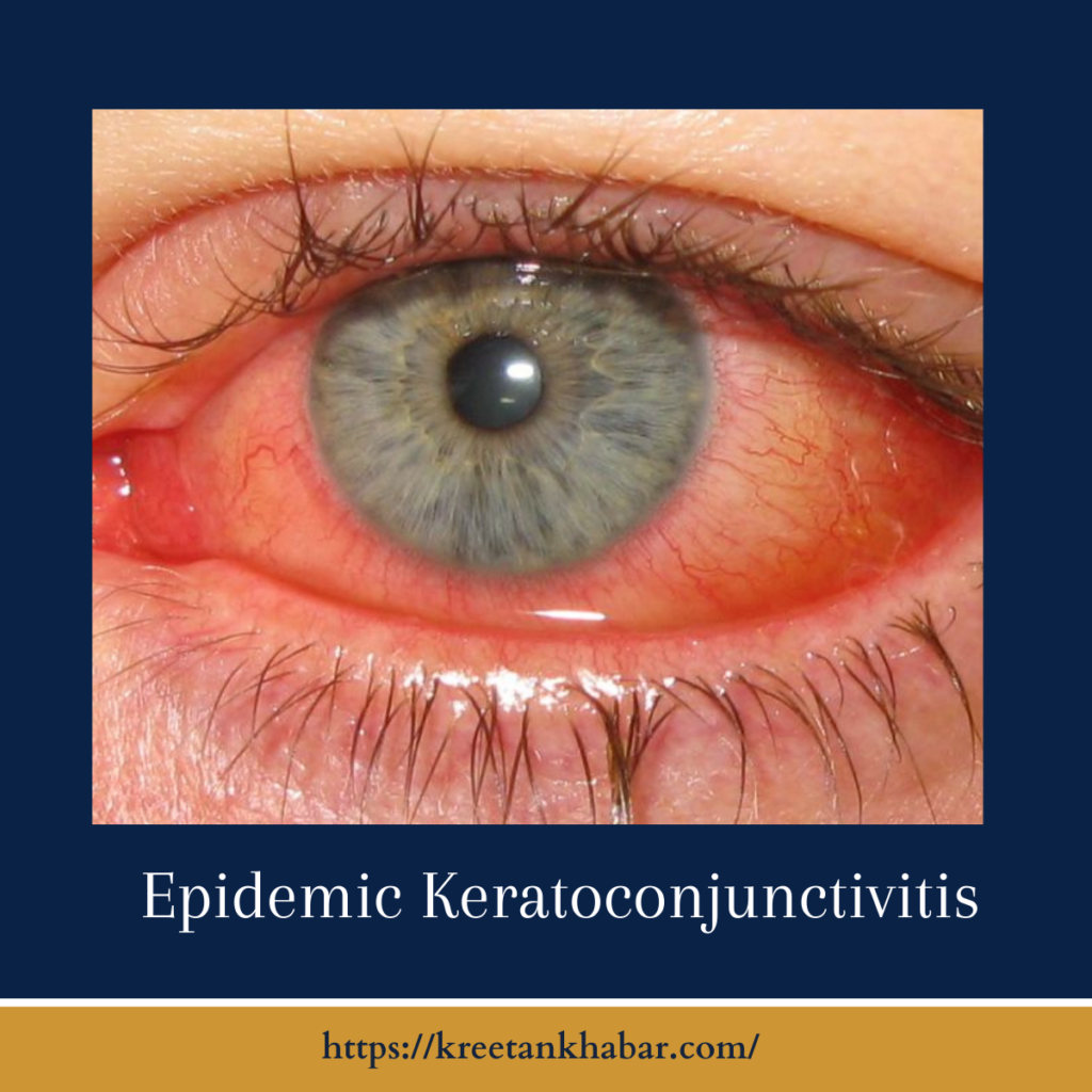 Epidemic Keratoconjunctivitis