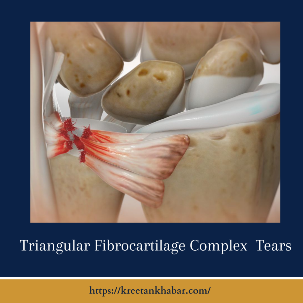 Triangular Fibrocartilage Complex  Tears