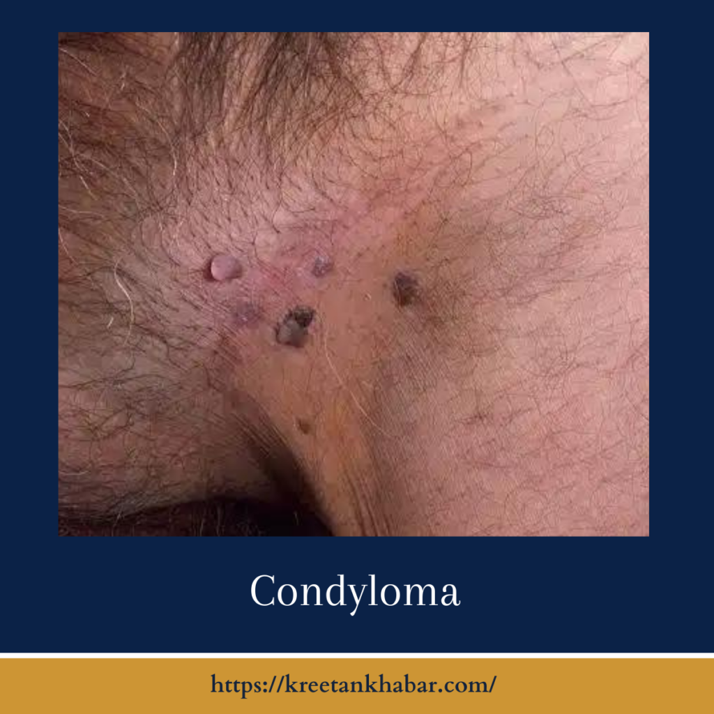 Condyloma