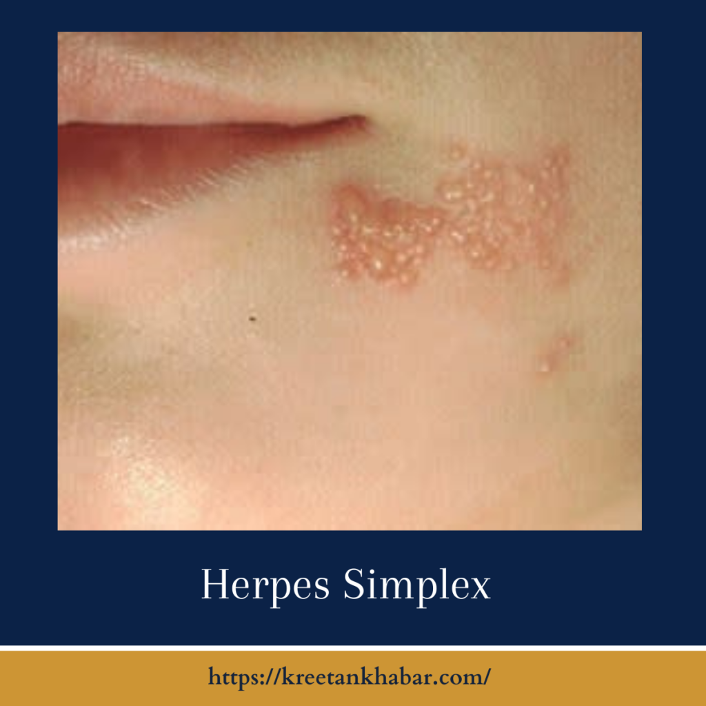 Herpes Simplex
