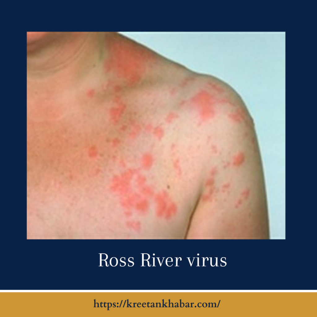Ross River virus 