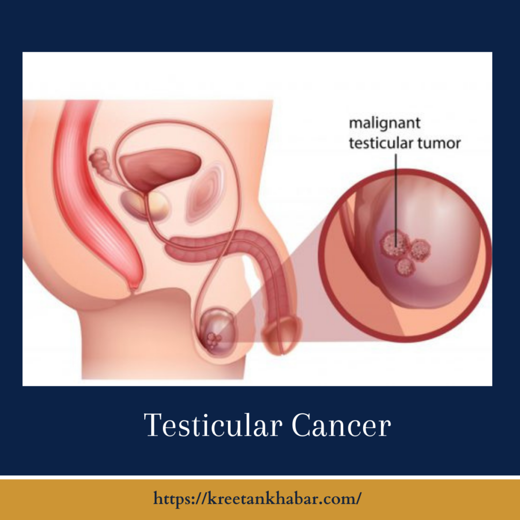 Testis cancer