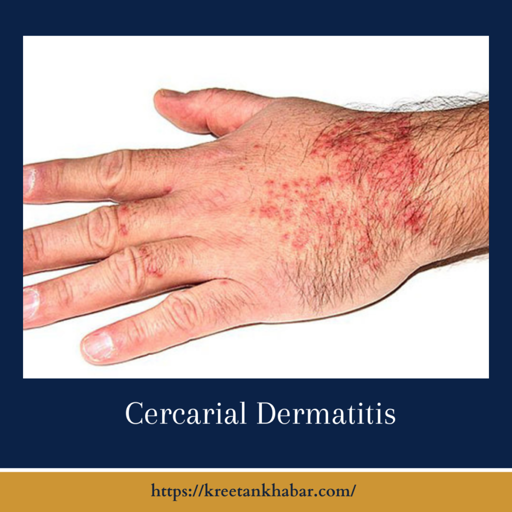 Cercarial Dermatitis