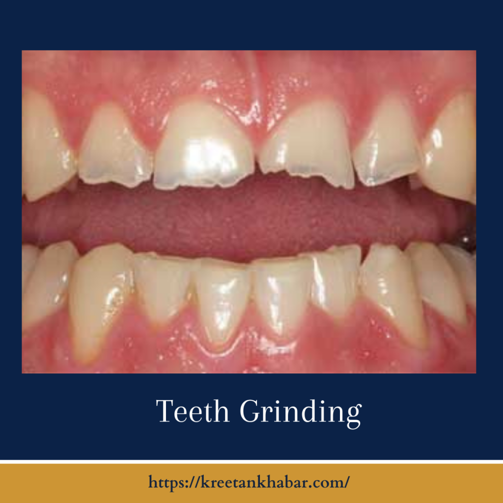 Teeth Grinding