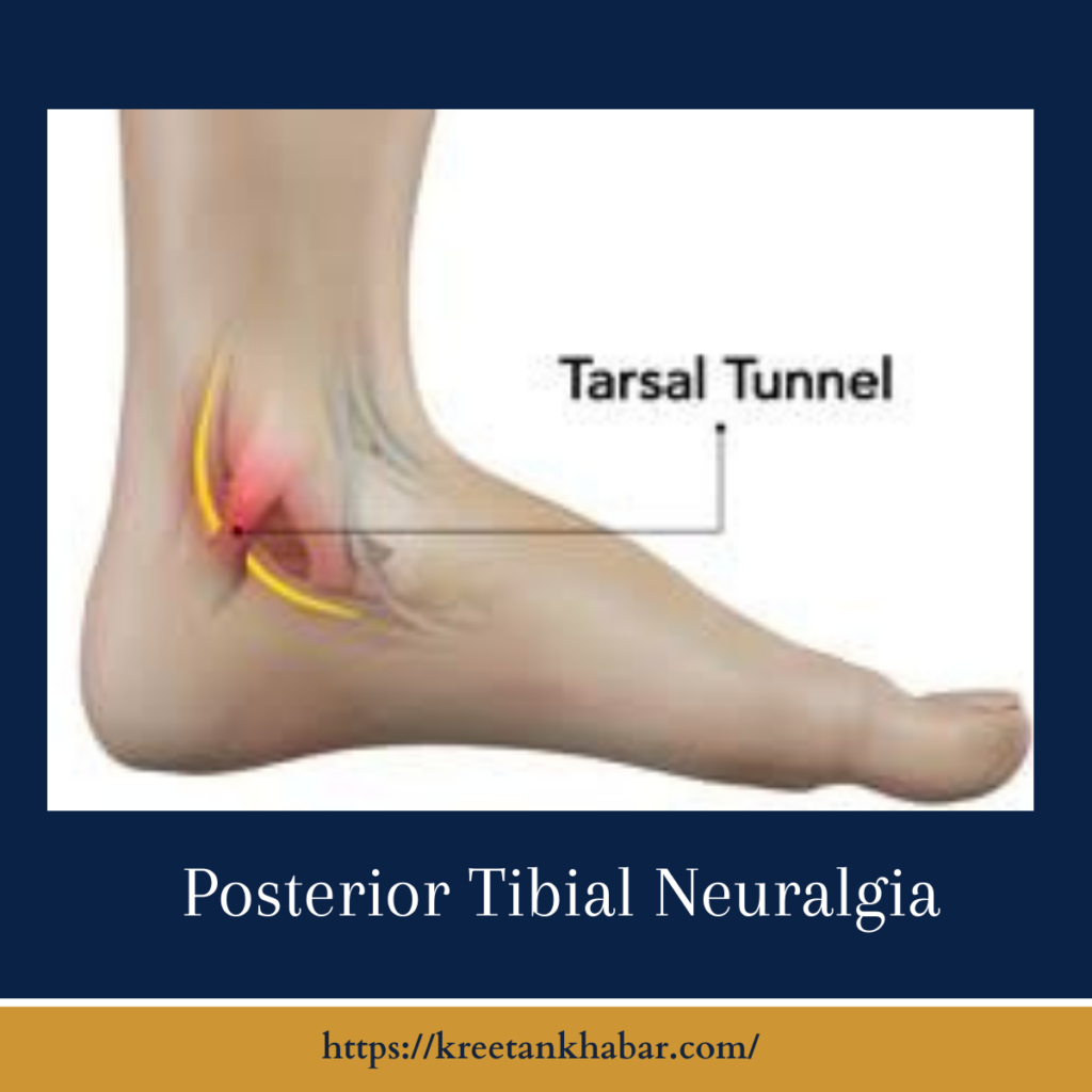 Posterior Tibial Neuralgia